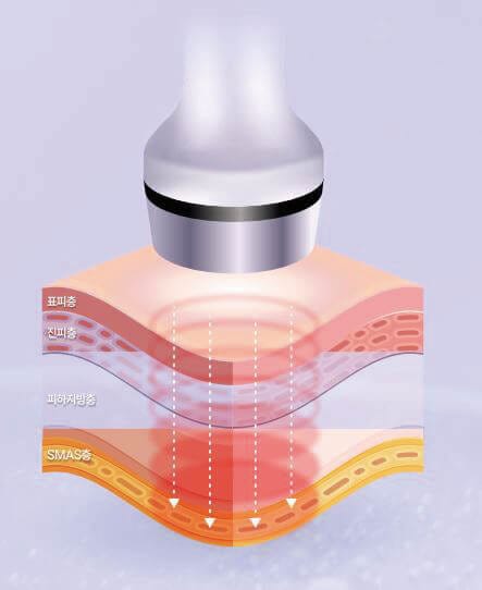 극초단파 리프팅의 작동 원리 정리