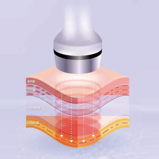 극초단파 리프팅의 작동 원리 정리