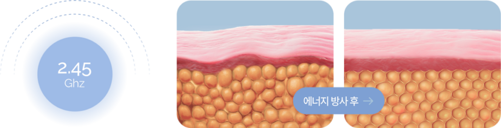 맥스 웨이브 시술 후 열 자극과 콜라겐 구조 변화